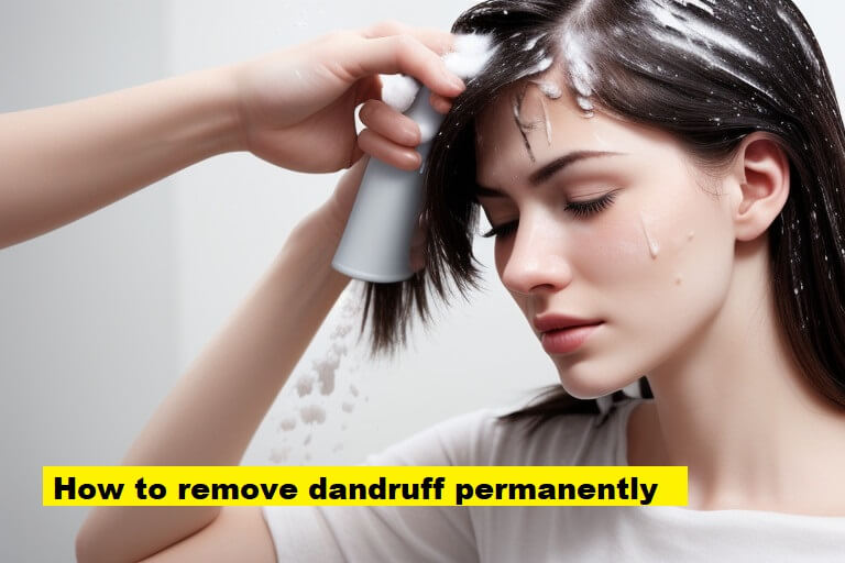 How to remove dandruff permanently